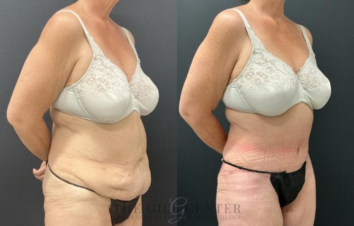 Tummy Tuck Case 820 Before & After Right Oblique | The Woodlands, TX | The Gill Center for Plastic Surgery and Dermatology