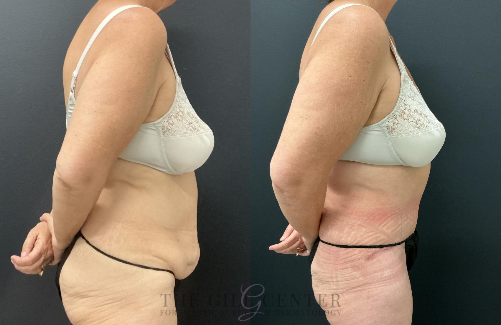 Tummy Tuck Case 820 Before & After Right Side | The Woodlands, TX | The Gill Center for Plastic Surgery and Dermatology